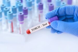 Torch test - Millenium Medic - Slavija, Vračar, Beograd