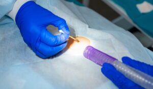 razlika između papiloma i kondiloma